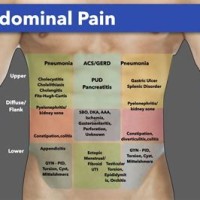 Abdominal Pain Chart And Symptoms