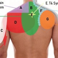 Back Shoulder Blade Pain Diagnosis Chart