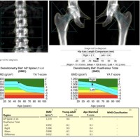 Bone Density Test Results Chart