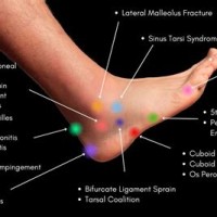 Bottom Foot Pain Diagnosis Chart