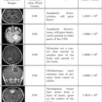 Brain Tumor Size Chart