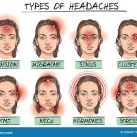 Chart Showing Types Of Headaches