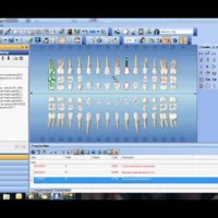 Charting Supernumerary Teeth In Dentrix