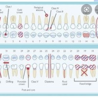 Charting Symbols In Dentistry