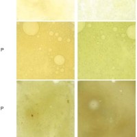 Copd Sputum Colour Chart