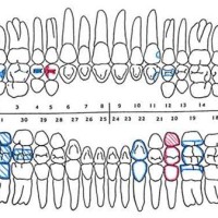 Dental Charting Symbols Quizlet