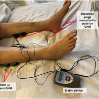 Estim Electrode Placement Chart