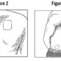 Fentanyl Patch Placement Chart