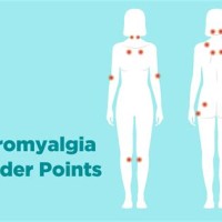 Fibro Tender Points Chart