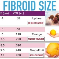 Fibroid Tumor Size Chart