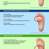 Foot Pain Symptom Chart