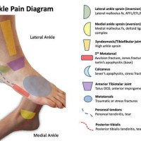 Heel Pain Diagnosis Chart - Best Picture Of Chart Anyimage.Org