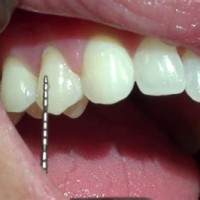 How To Chart Gingival Recession