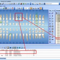 How To Chart Missing Teeth On Dentrix