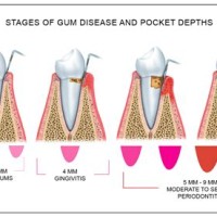 How To Chart Periodontal Probing