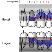 How To Chart Recession On Dentrix