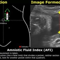 How To Read Amniotic Fluid Index Chart