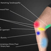 Inner Knee Pain Location Chart