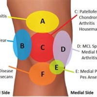 Inside Knee Pain Diagnosis Chart