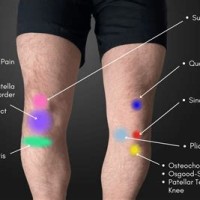 Knee Pain Location Chart