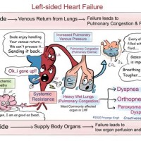 Left Vs Right Heart Failure Chart