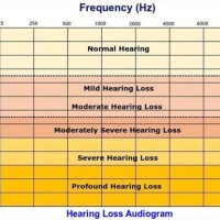 Level Of Hearing Loss Chart 2022 Canada