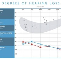 Level Of Hearing Loss Chart 2022