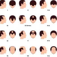 Male Pattern Baldness Chart