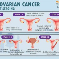 Ovarian Tumor Size Chart