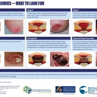 Pressure Ulcer Sing Chart