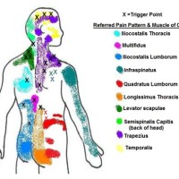 Referred Back Pain Chart