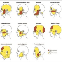 Referred Dental Pain Chart