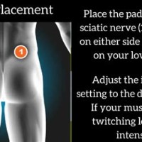 Sciatica Tens Pad Placement Chart