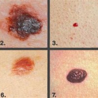 Skin Cancer Identification Chart