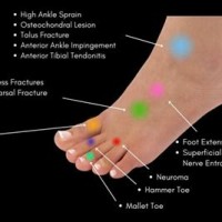 Top Foot Pain Diagnosis Chart