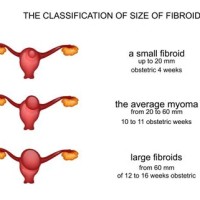 Treatment Uterine Fibroid Size Chart