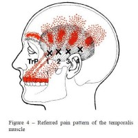 Trigeminal Neuralgia Referred Tooth Pain Chart