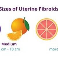 Uterine Fibroid Size Chart In Mmol L