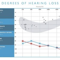 Va Hearing Loss Mos Chart