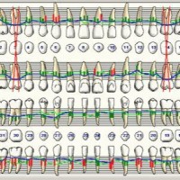 What Does Perio Charting Mean