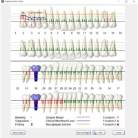 What Does Periodontal Charting Include