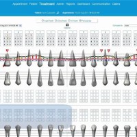 What Is A Full Periodontal Charting