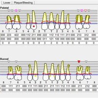 What Is Cal In Periodontal Charting