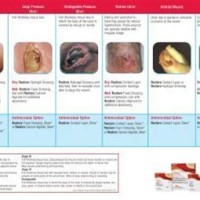 Wound Dressing Selection Chart